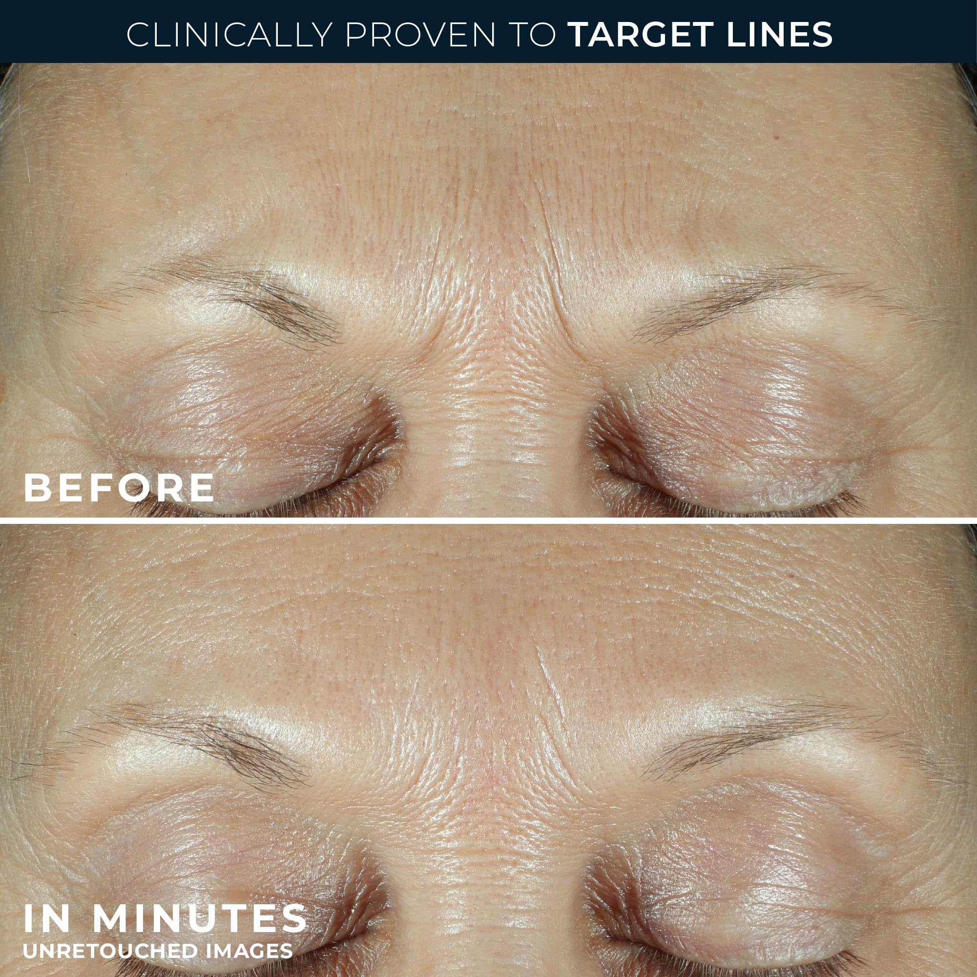 RoC Correxion targeting eleven lines between brows for deep lines