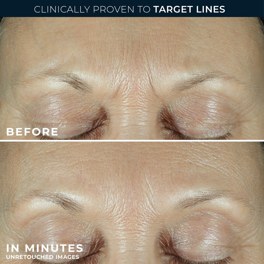 RoC Correxion targeting eleven lines between brows for deep lines
