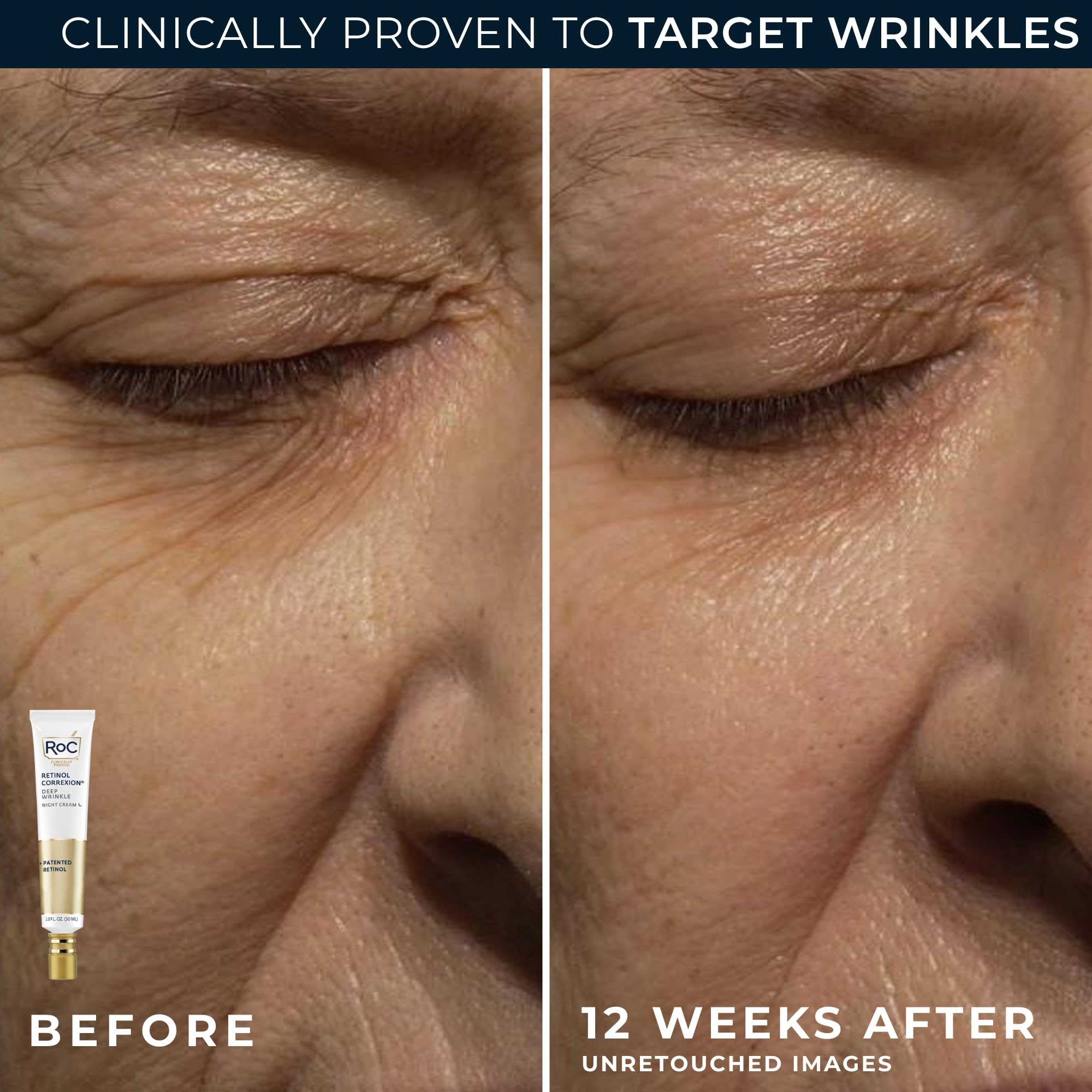 RoC Retinol Correxion Eye Cream closeup for under-eye care and wrinkle reduction