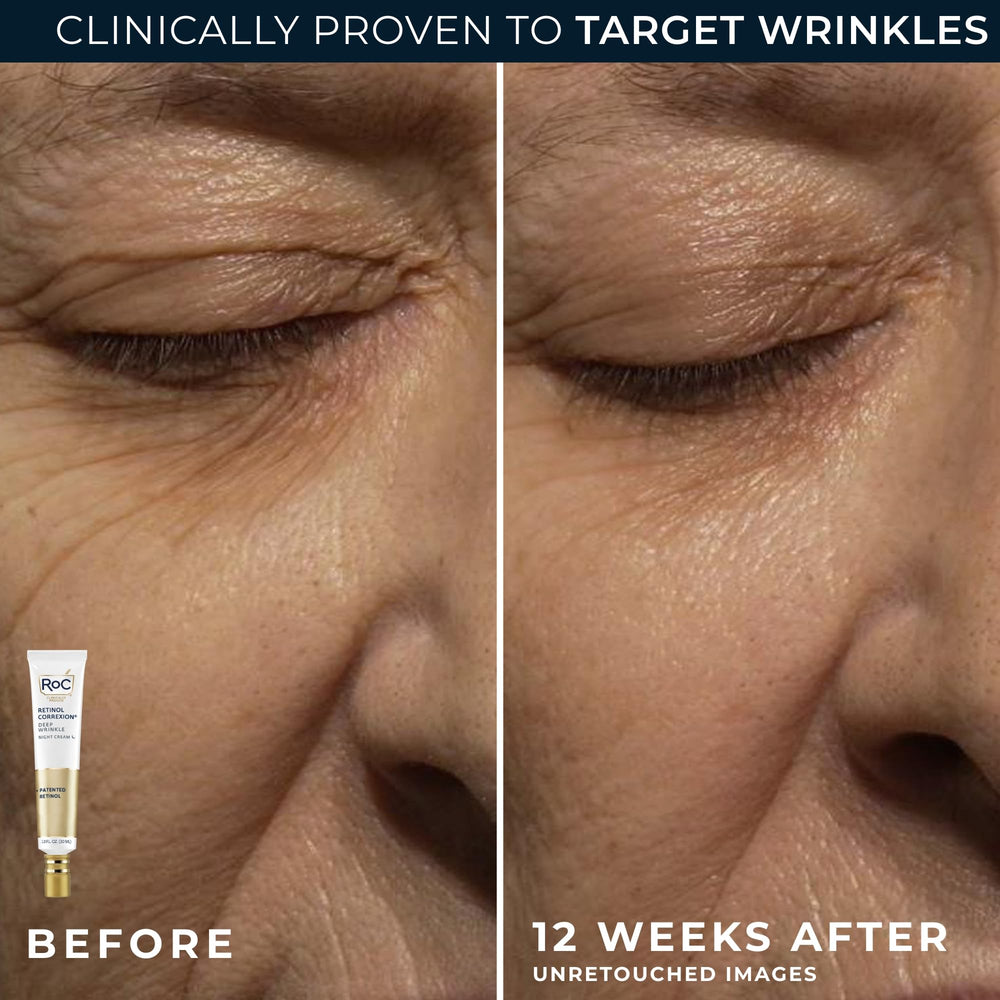 RoC Retinol Correxion Eye Cream closeup for under-eye care and wrinkle reduction