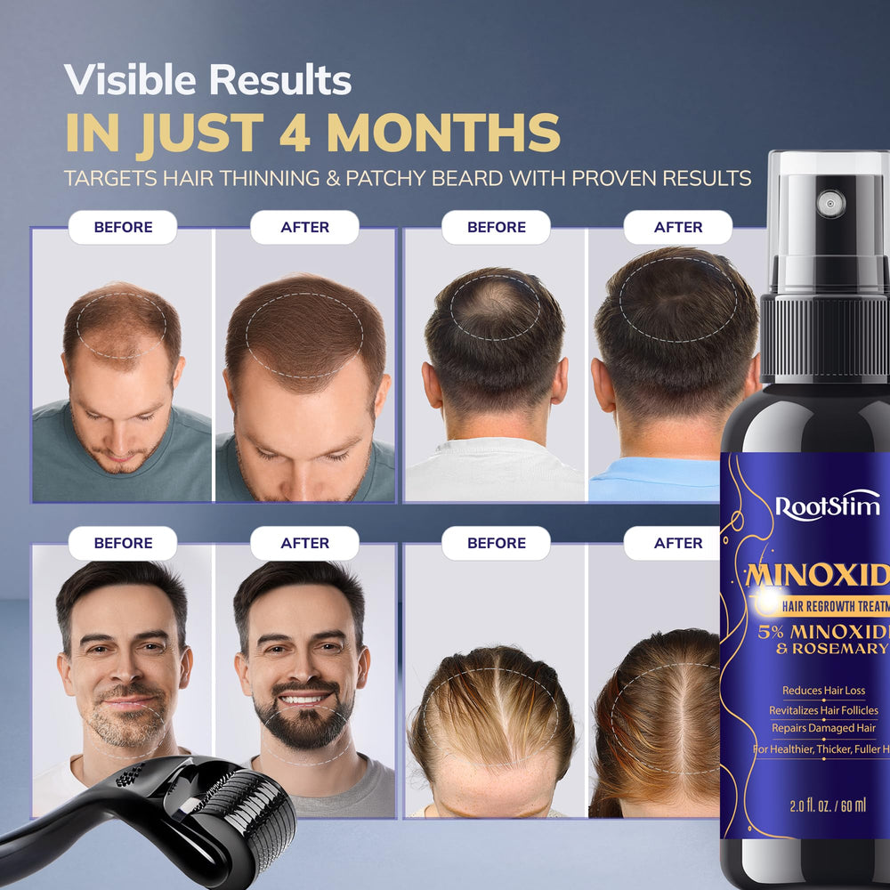 RootStim Minoxidil application on beard area for fuller-looking facial hair