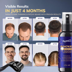 RootStim Minoxidil application on beard area for fuller-looking facial hair