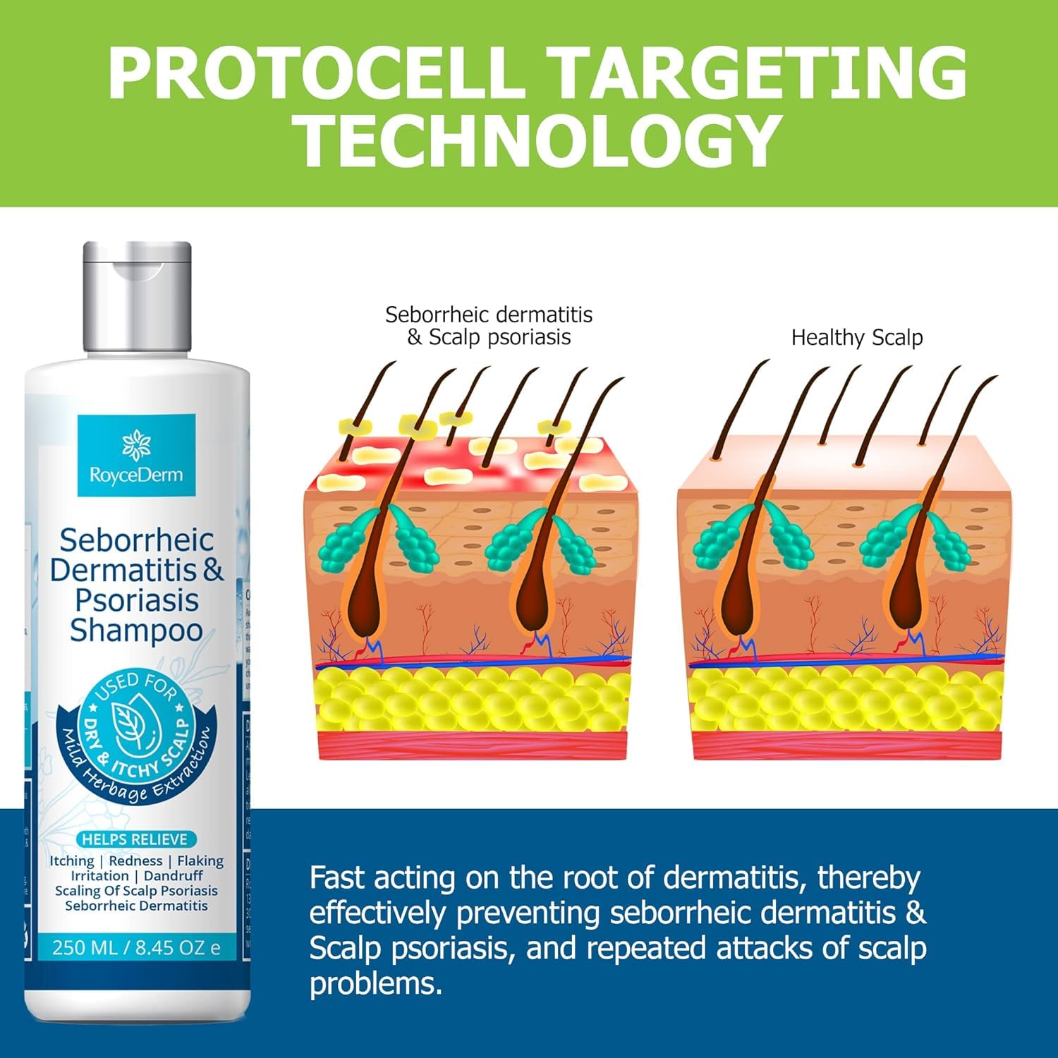 Roycederm folliculitis shampoo application on damp hair for cleansing