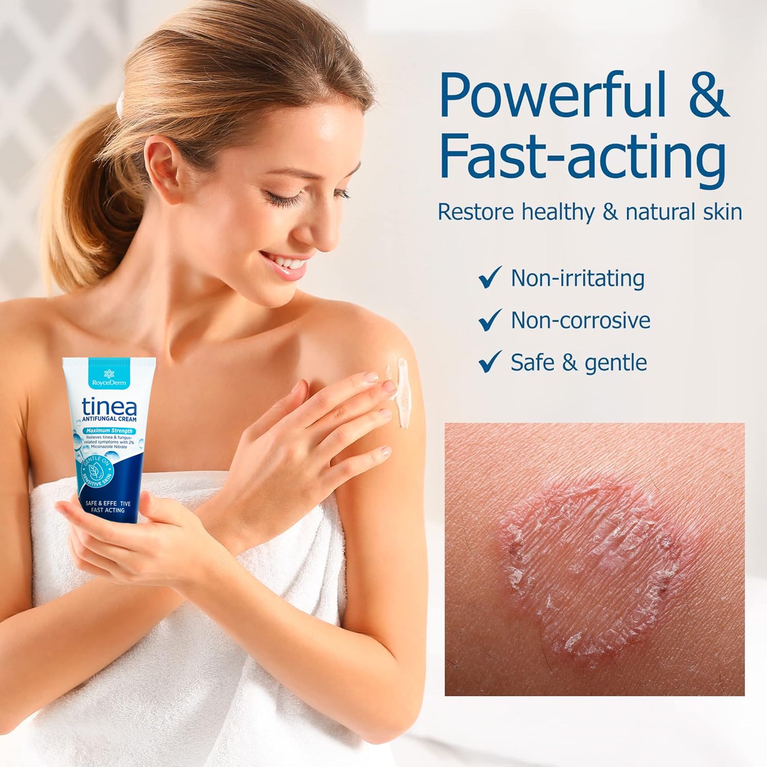 Roycederm tinea treatment tube ready for easy, on-the-go application.
