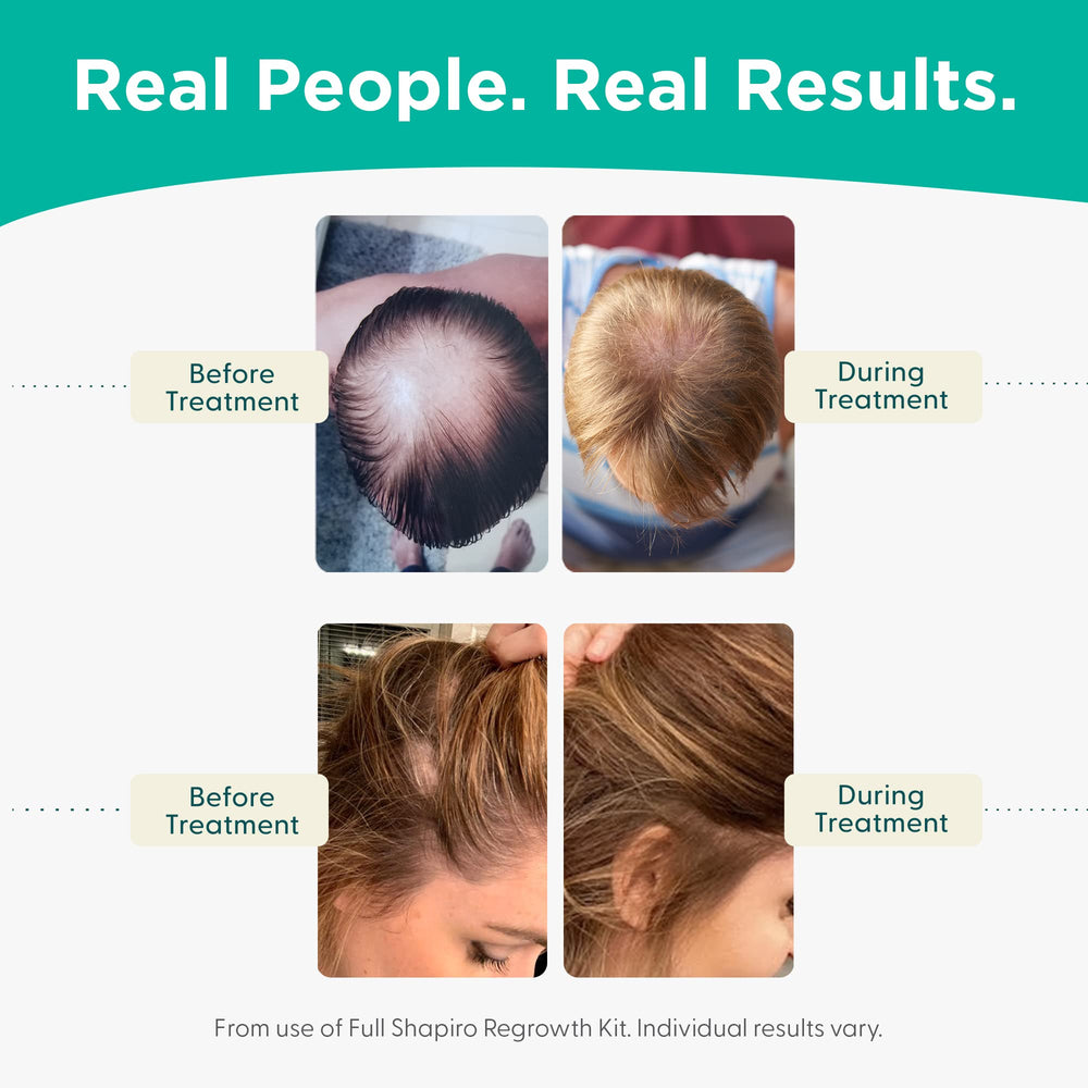 Person applying shampoo in daily cleansing routine with Shapiro MD product.