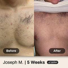 Shield Men's Acne Body Wash shoulders care keeps shoulders clean and refreshed.