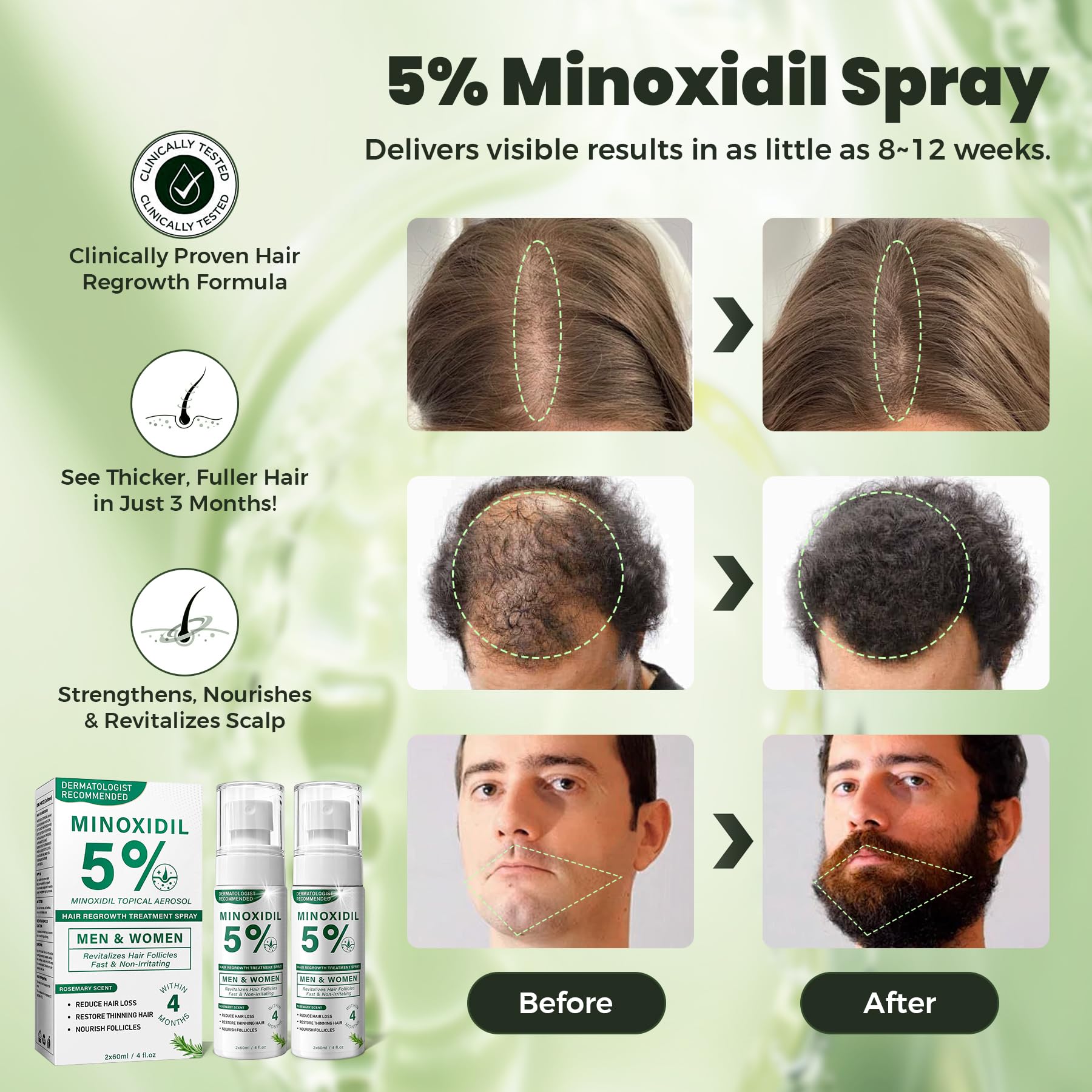 SHIUMORE Minoxidil fine-mist dispersing evenly without greasiness