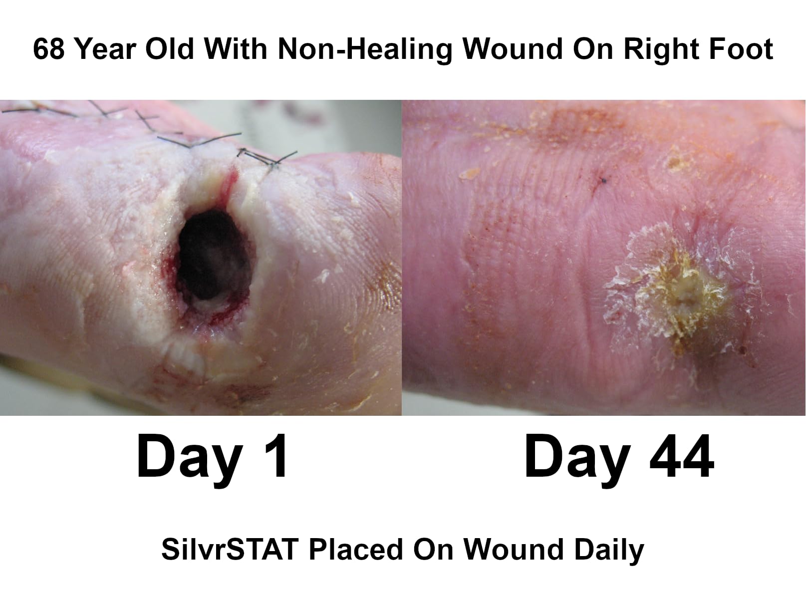 Open SilvrSTAT bottle dispensing gel onto a bandage