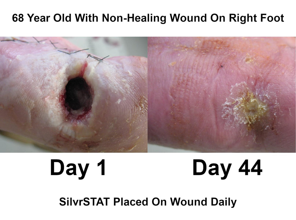 Open SilvrSTAT bottle dispensing gel onto a bandage