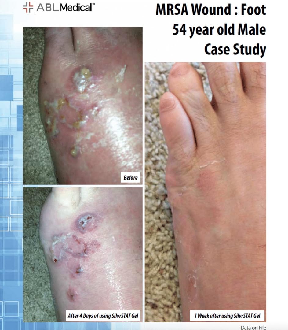 SilvrSTAT gel for skin care and minor wound care use case