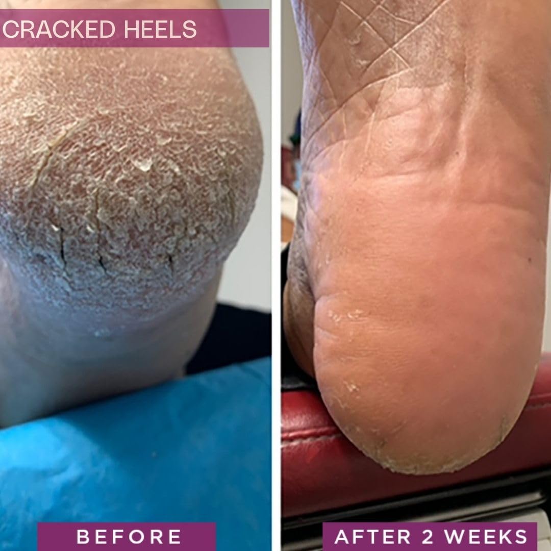 SkinIntegra Rapid Crack Repair Cream applied to diabetic foot, soothing dry skin