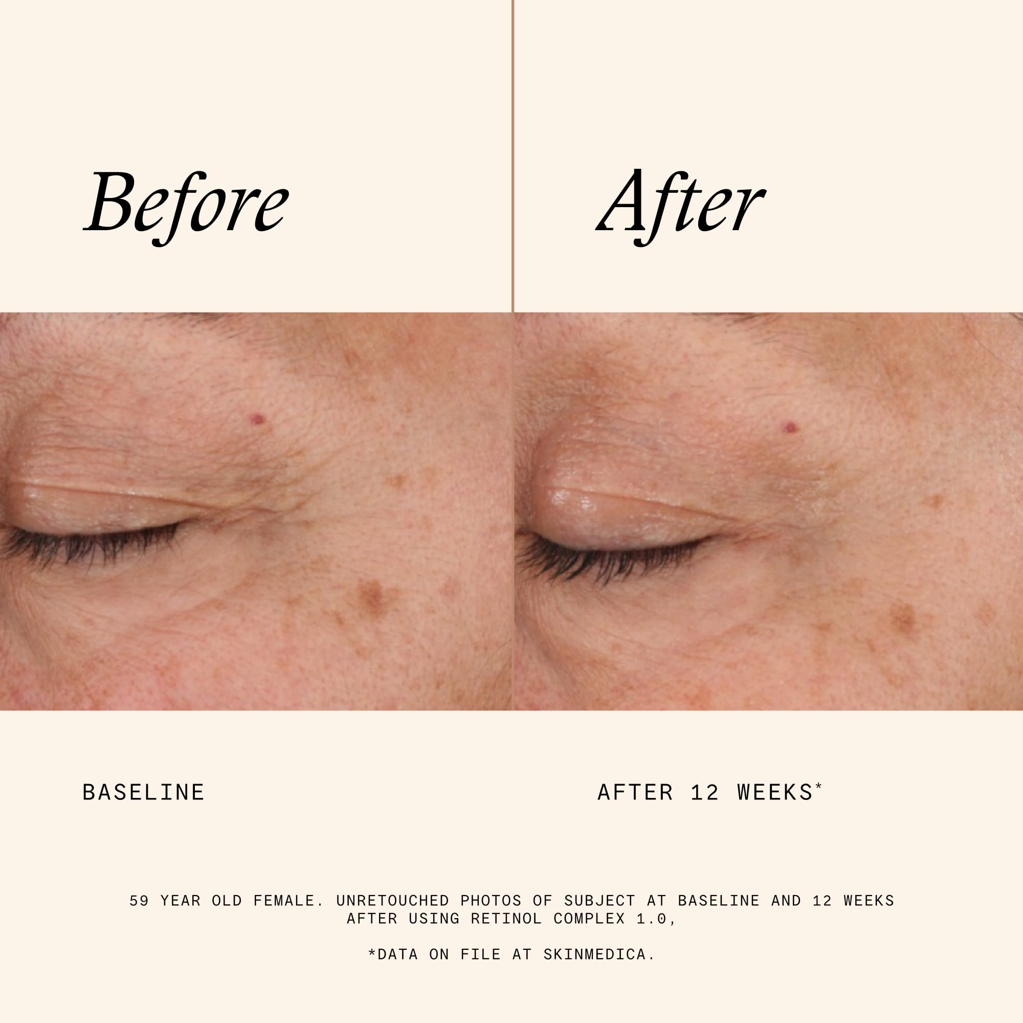 SkinMedica Retinol 1.0 Complex texture close-up shows creamy consistency.
