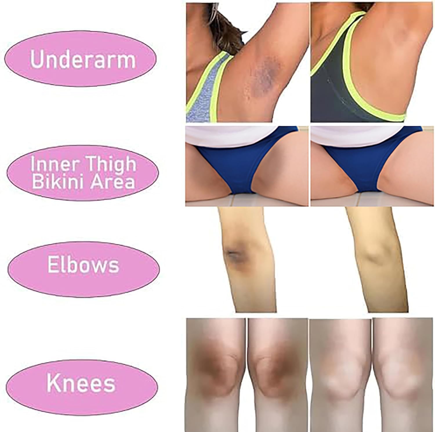 SMILEFACE underarm cream application demonstrates even coverage for smoother skin tone.