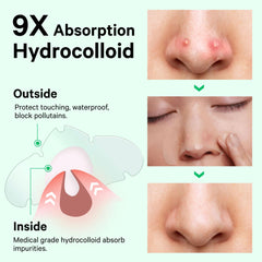 Sosky nose patch four-hour effect visualizing pore refinement and blemish reduction potential.