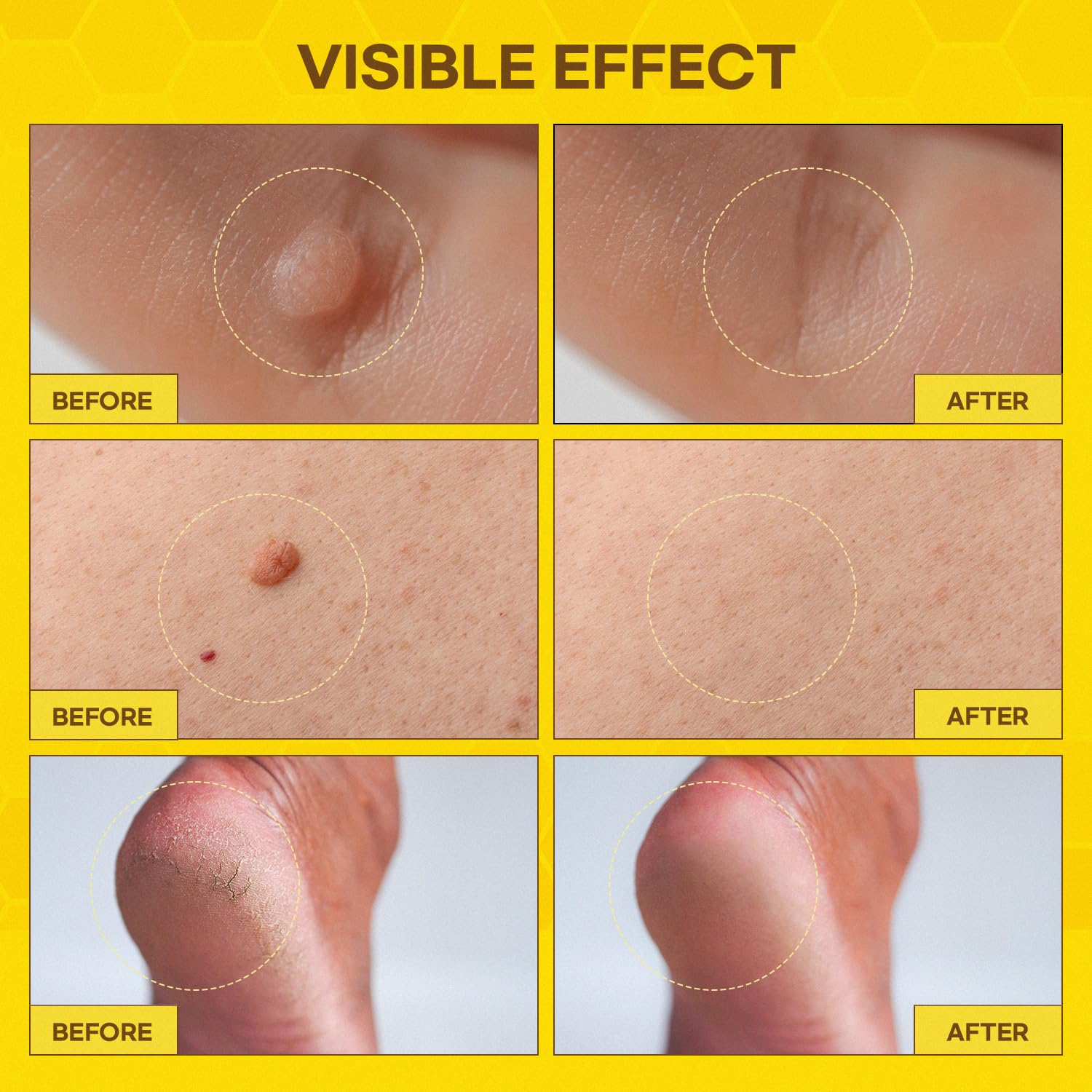 User applying SupreH treatment on plantar area with comfortable grip