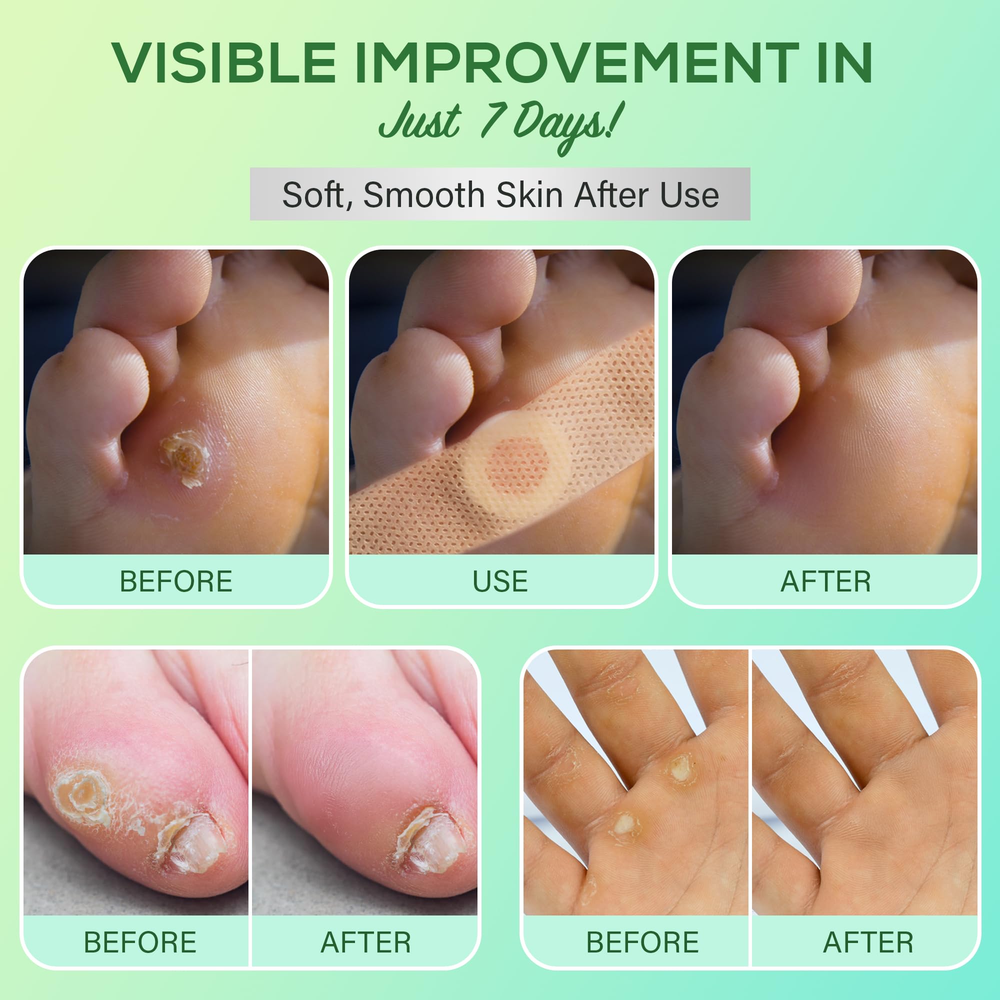 SupreH corn removers application step showing clean-area prep and bandage placement