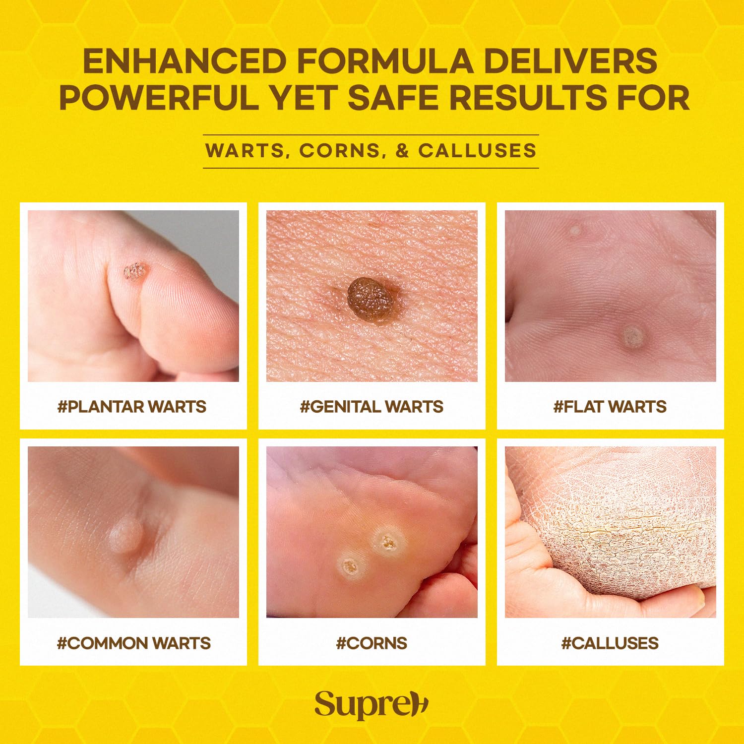 Close-up of SupreH wart remover applicator applying solution to affected skin