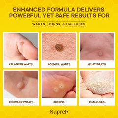Close-up of SupreH wart remover applicator applying solution to affected skin