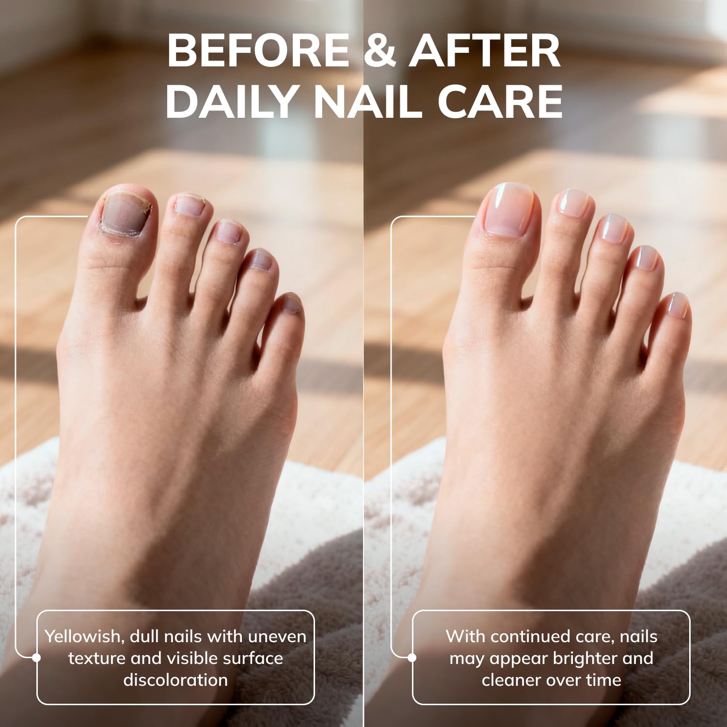 Swissklip KlearNail nail appearance before treatment