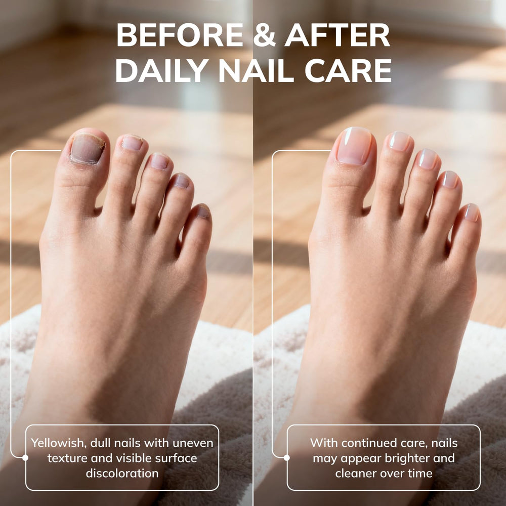 Swissklip KlearNail nail appearance before treatment