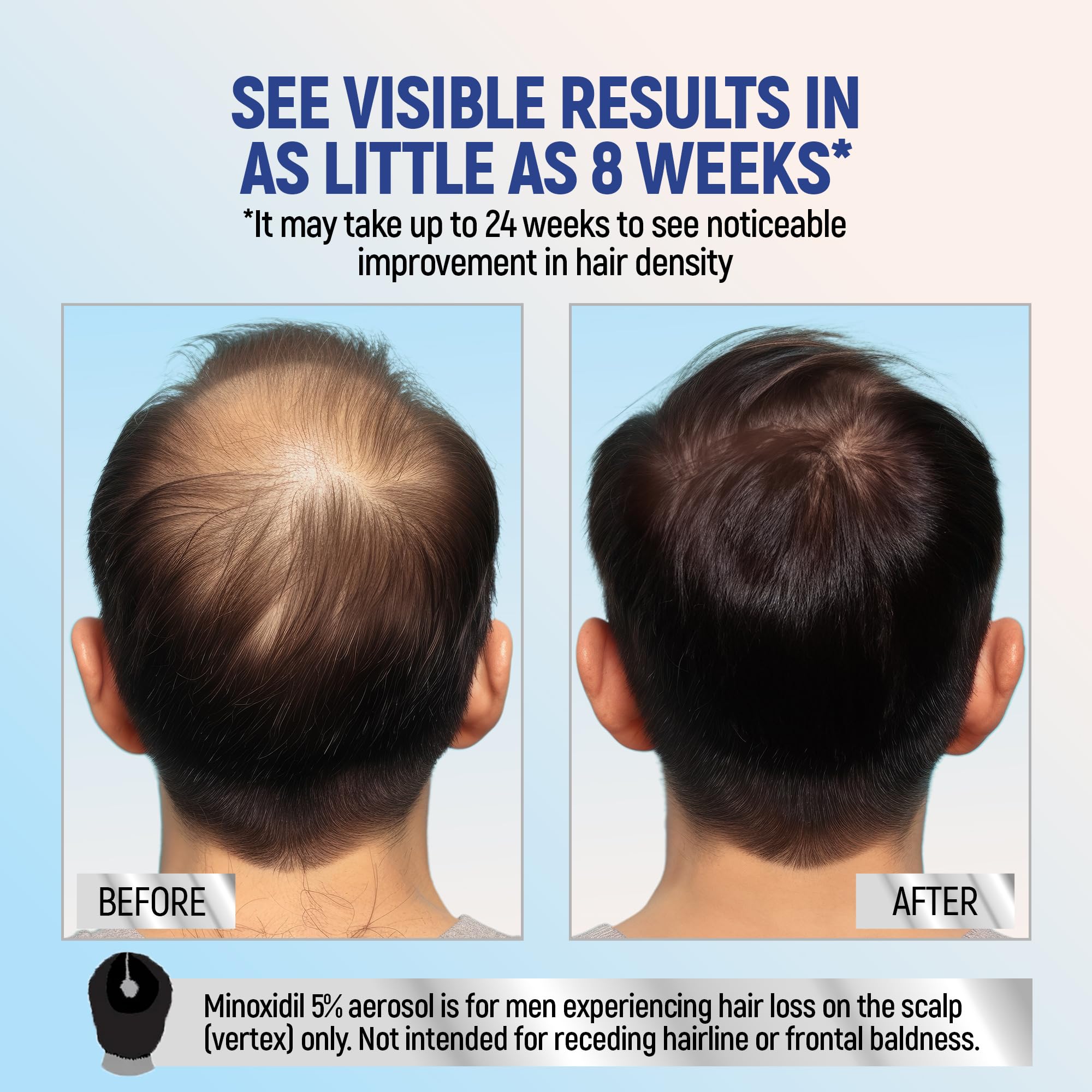 Close-up of TARO Minoxidil 5% foam being applied to the scalp.