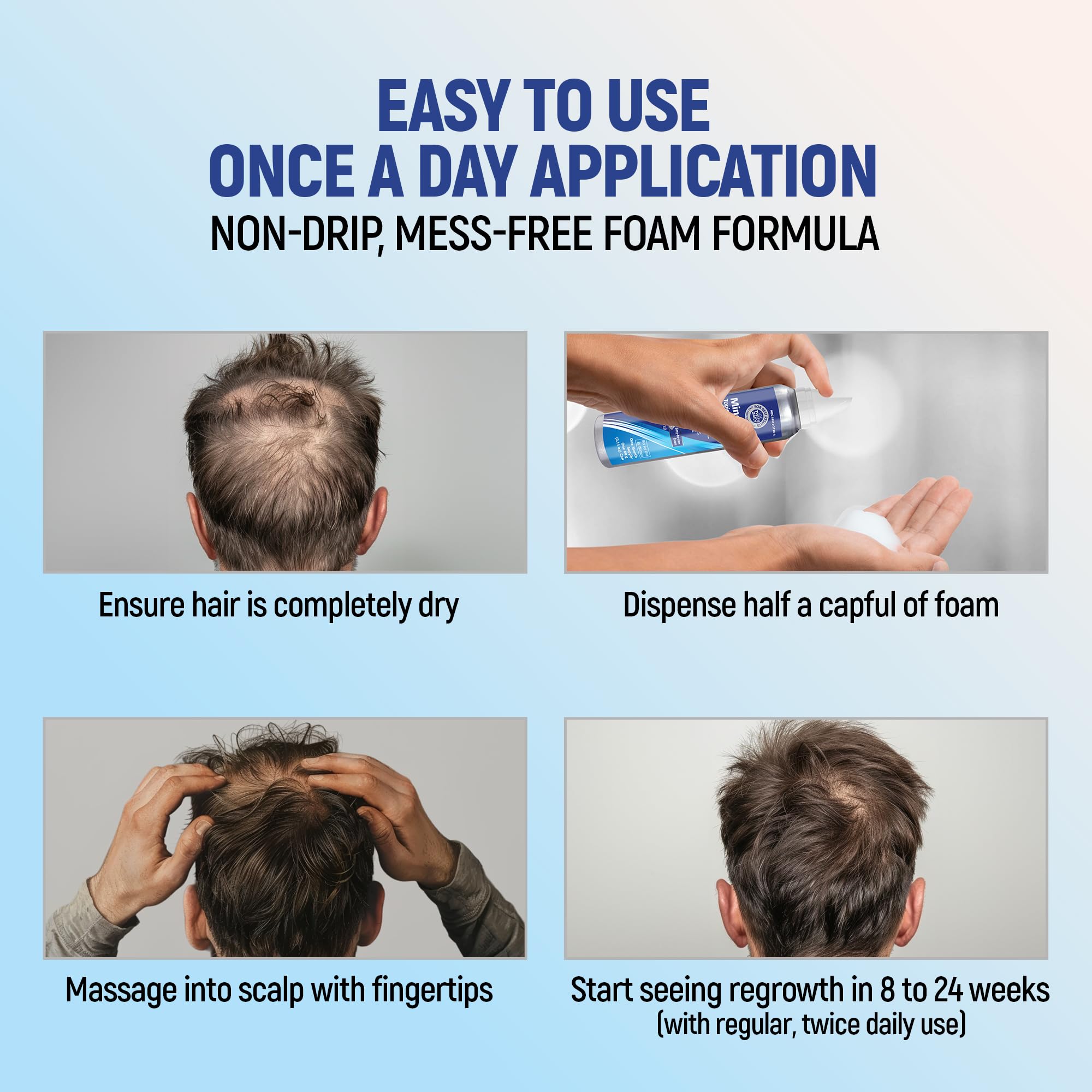 TARO Minoxidil 5% foam shows light, non-greasy texture for comfortable use.