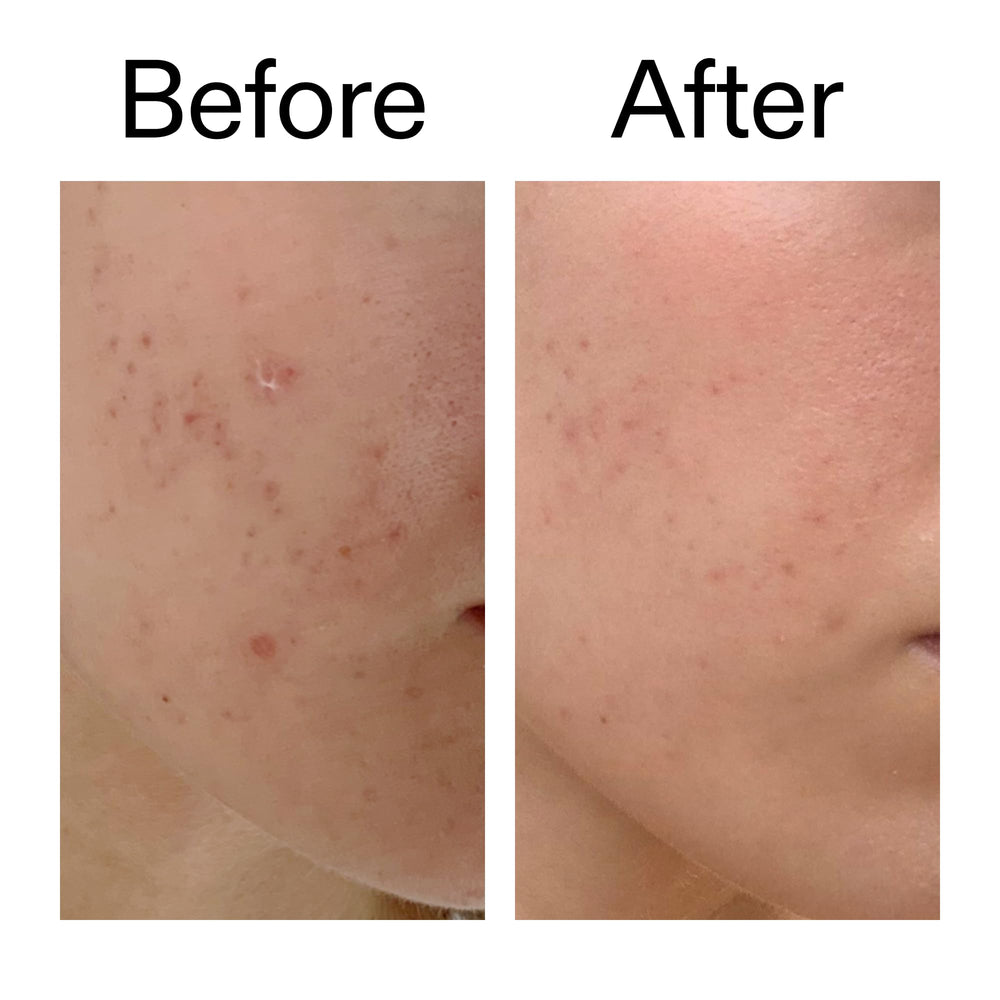 Before-after style hint of improved, even-toned skin with continued use.