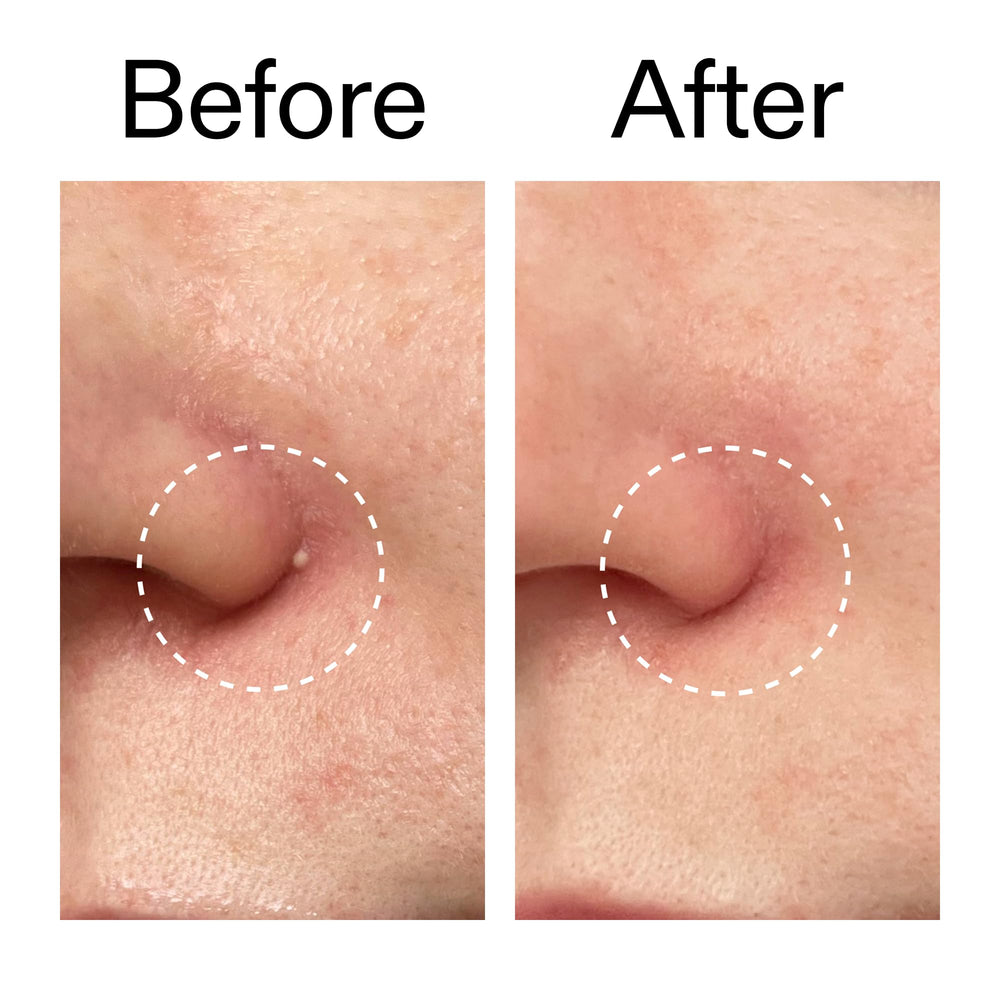 The INKEY List patch application demonstrates simple, fast use on cleansed skin.