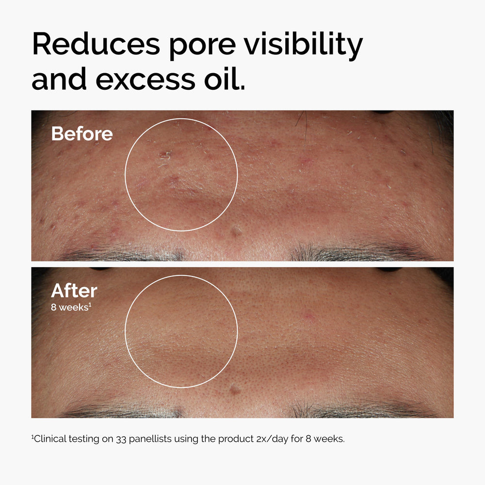 The Ordinary Niacinamide 10% + Zinc 1% application in routine