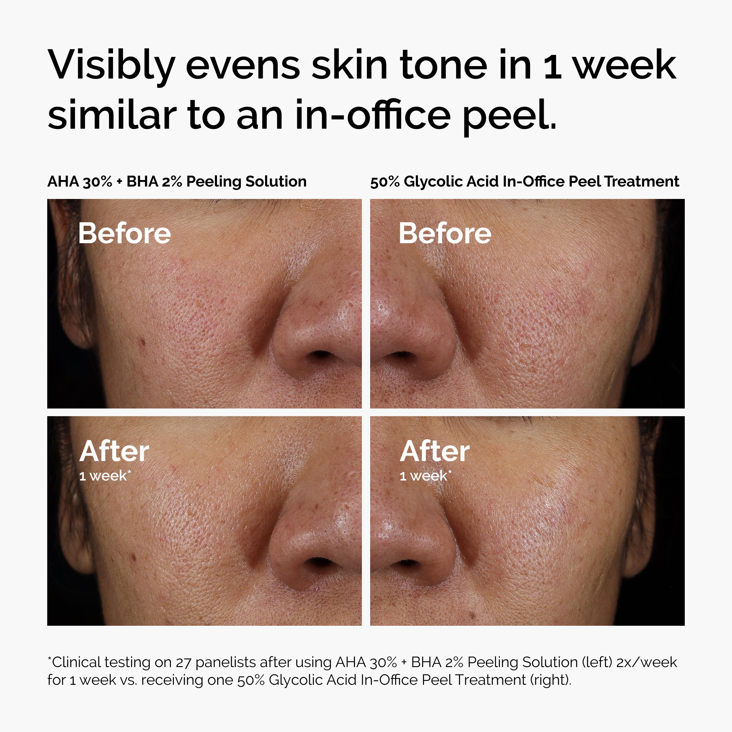 The Ordinary peeling solution being poured for application.