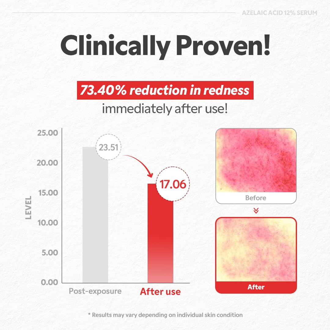 TIRTIR Azelaic Acid 12% serum zinc PCA and skincare science graphic.