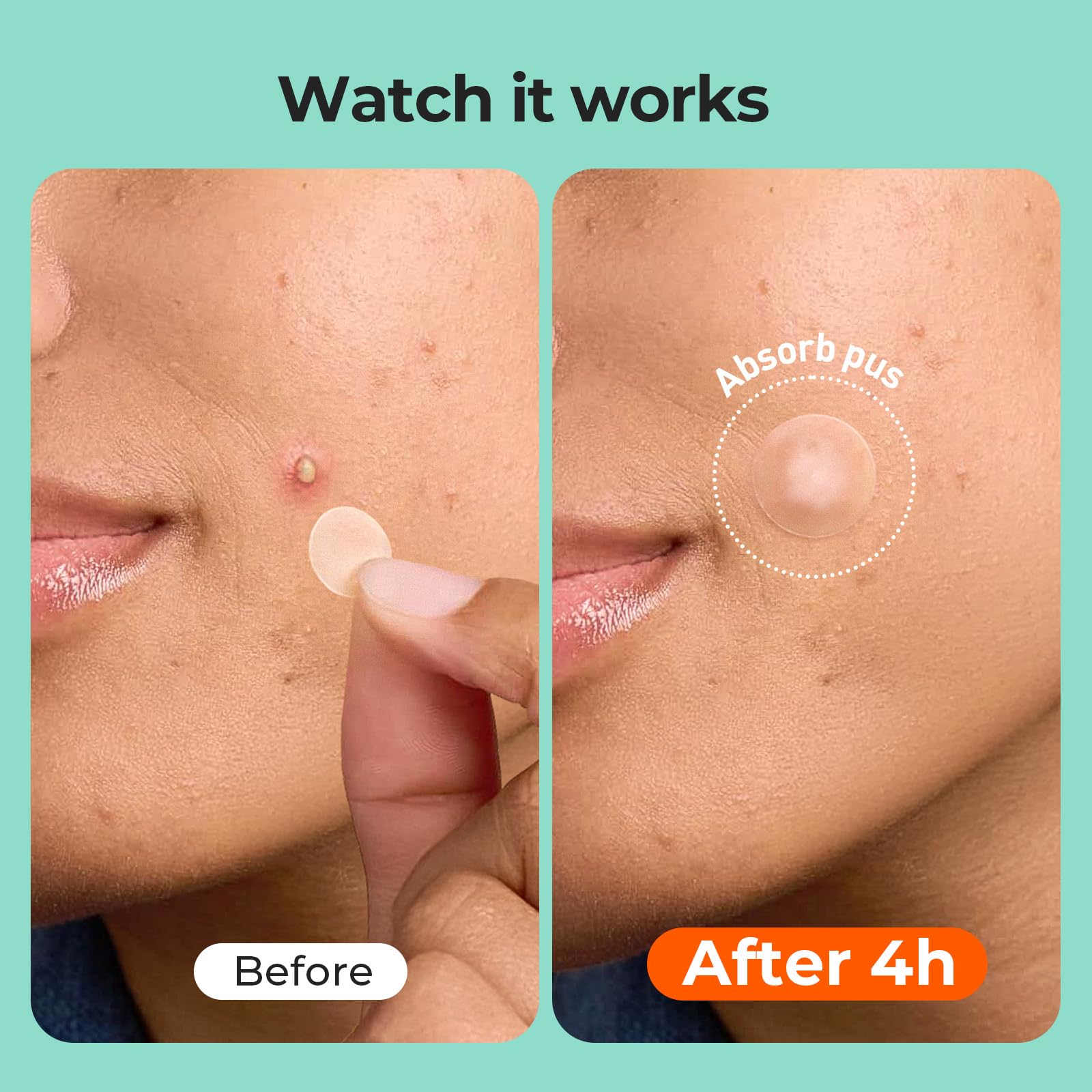 TKTK Hydrocolloid Patches demonstrate absorption action on a blemish