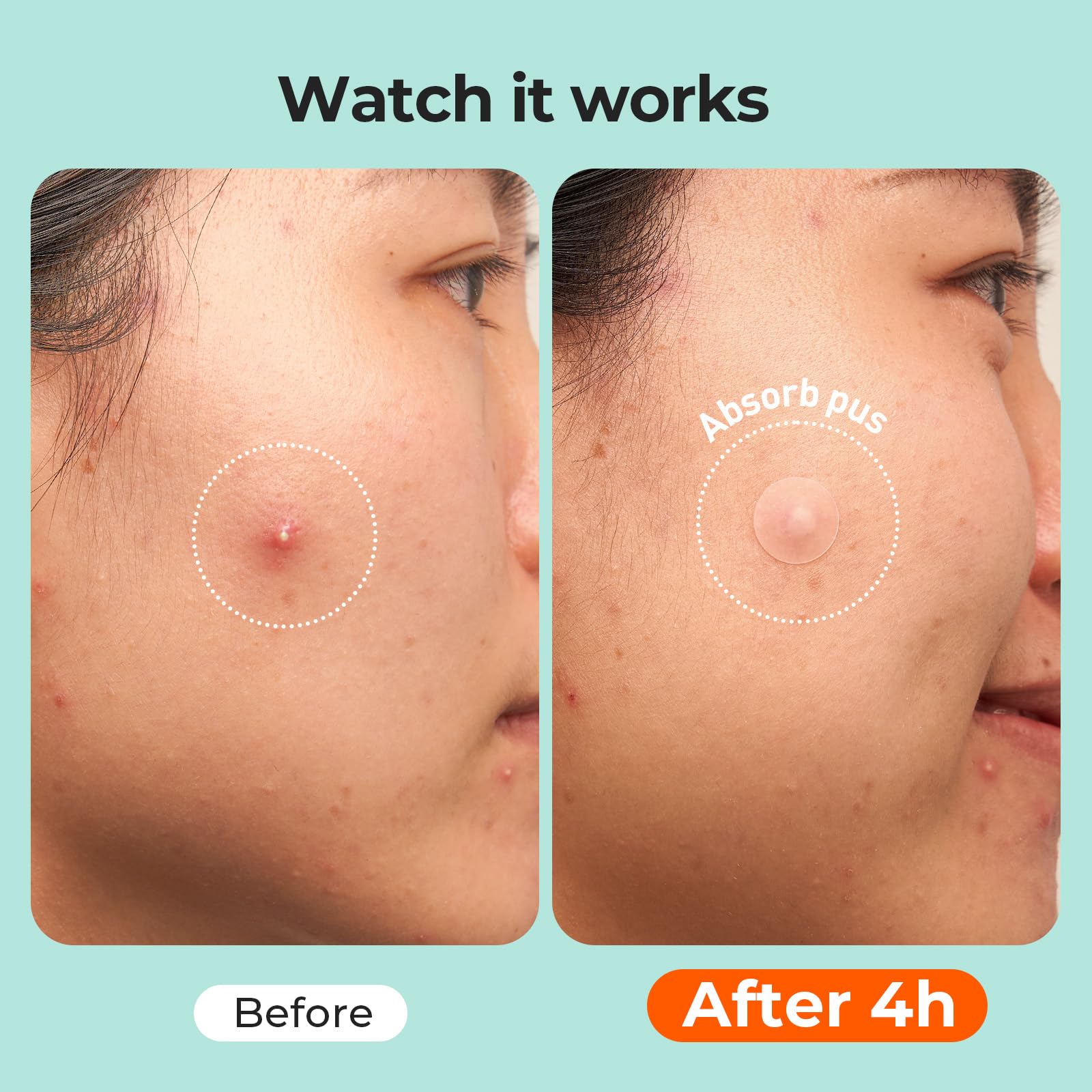 TKTK overnight patch coverage helps flatten appearance by morning.