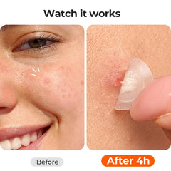 TKTK Pimple Patches absorb oil in about five hours to reduce shine.