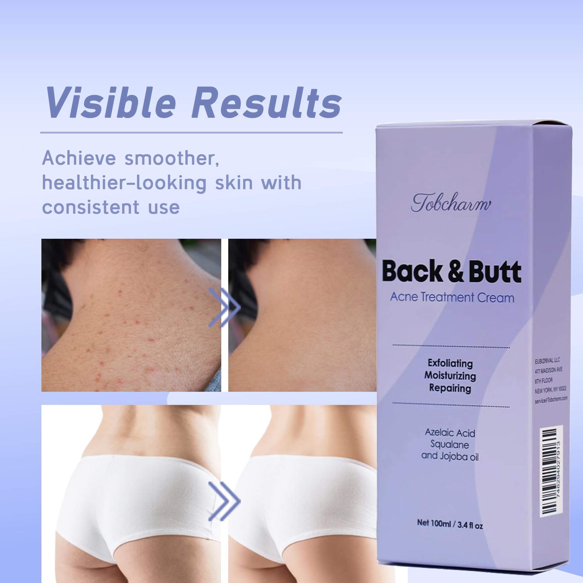 Tobcharm Acne reduction before-after panel highlights improved tone and clearer skin