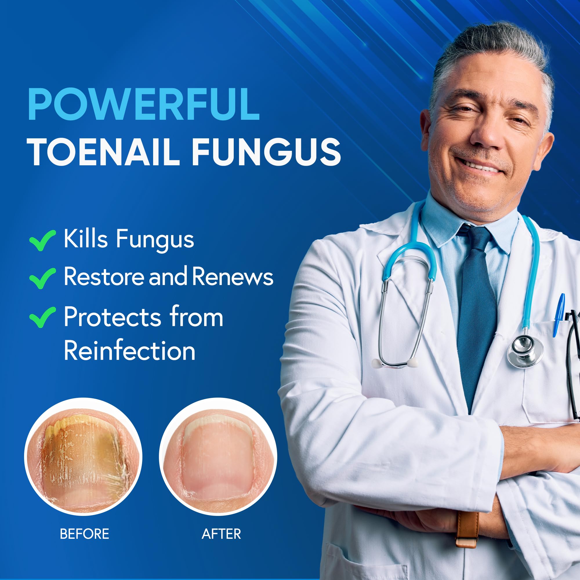 Tobcharm toenail fungus treatment cream in use on nails supports symptom relief.