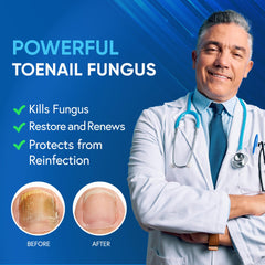 Tobcharm toenail fungus treatment cream in use on nails supports symptom relief.