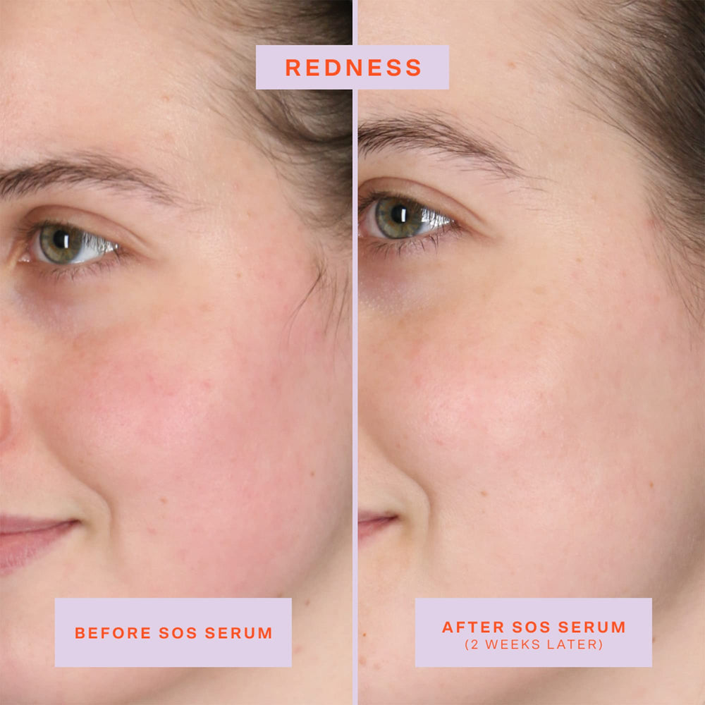 Tower 28 SOS Rescue Face Serum being applied to skin, soothing irritated areas.