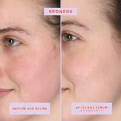 Tower 28 SOS Rescue Face Serum being applied to skin, soothing irritated areas.