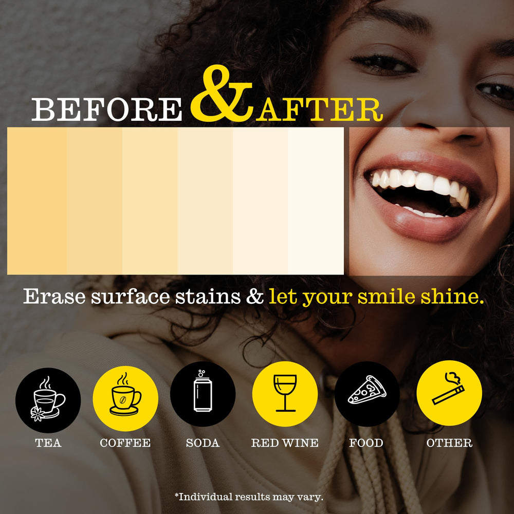 Close-up of strips on teeth during a 30-minute whitening session.