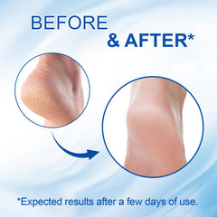 Urea Foot Care Stick treats calluses with targeted softening.