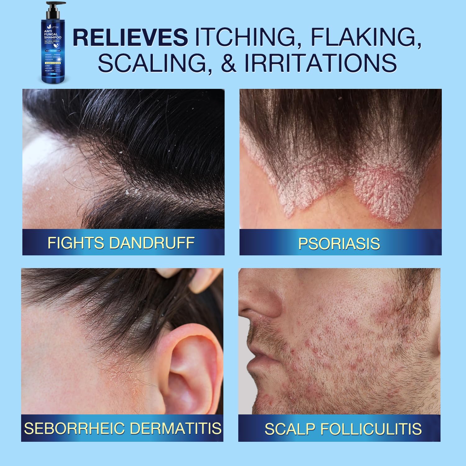 Uttse shampoo lather on scalp indicating mild cleansing with salicylic acid.