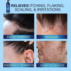 Uttse shampoo lather on scalp indicating mild cleansing with salicylic acid.