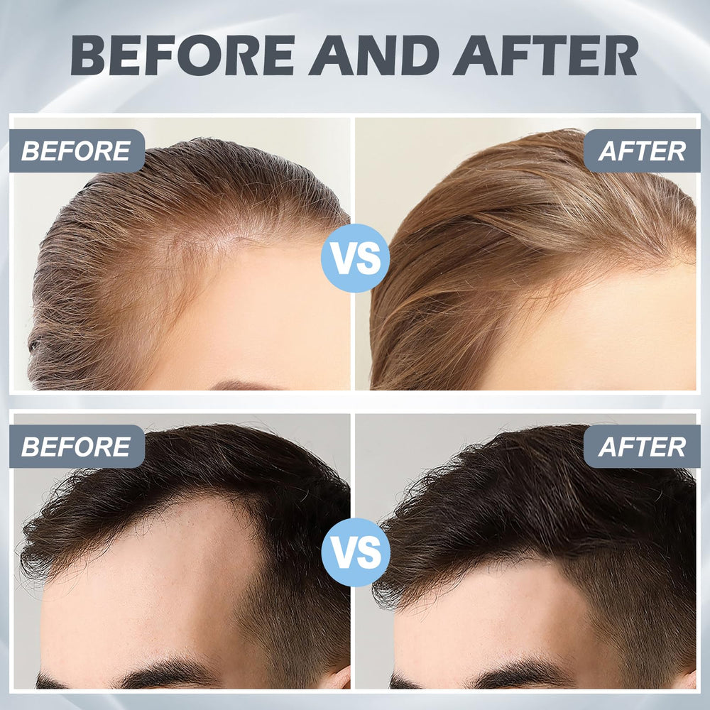 VANKEPYO derma roller for hair aids scalp care during routine sessions.