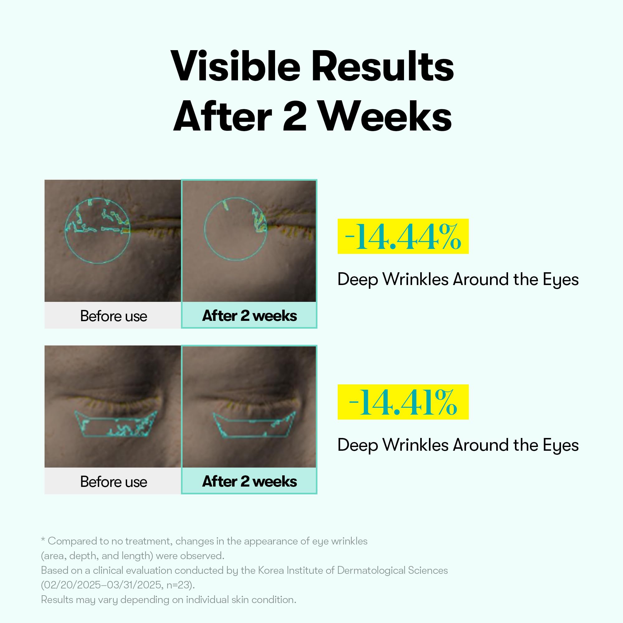 VT COSMETICS PDRN Reedle Shot micro-vibration device enables consistent, gentle eye-area treatment.