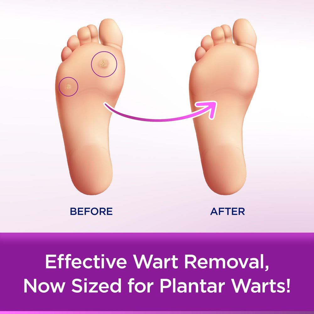 WartStick Plantar shows fast, painless removal for feet.