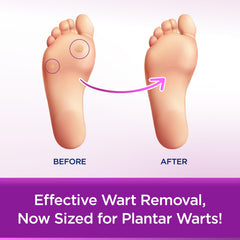 WartStick Plantar shows fast, painless removal for feet.