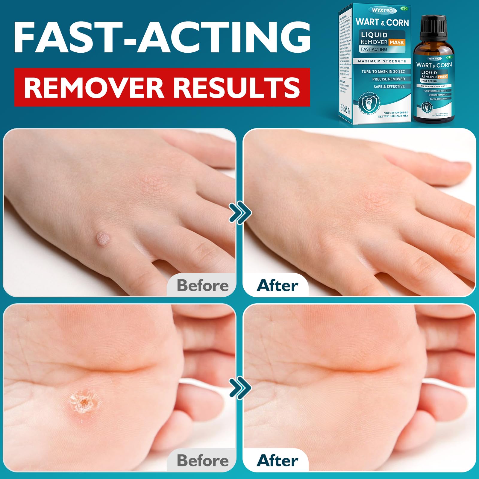 WYXTRO Wart Remover on the foot showing multi-area use