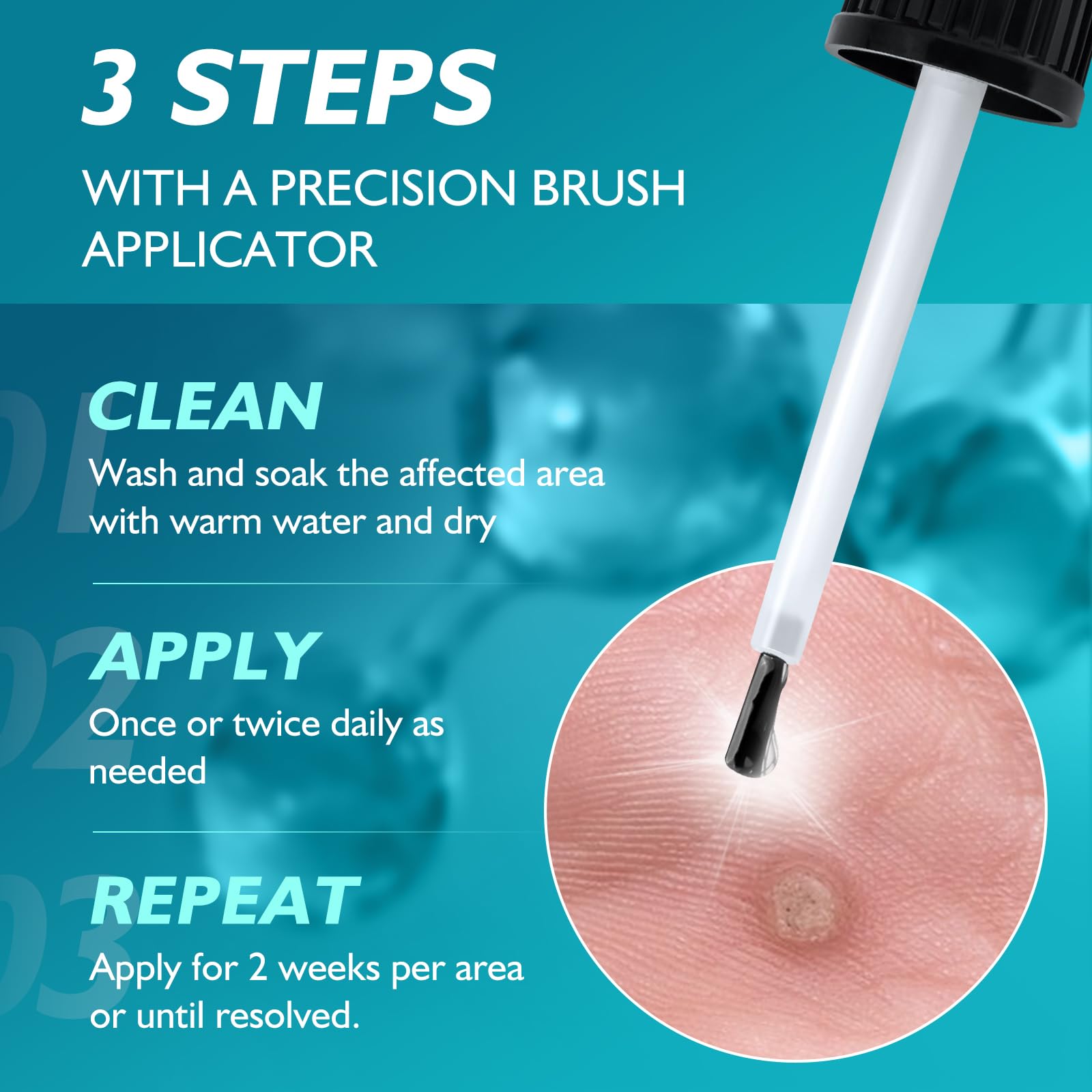 WYXTRO multi-use solution for warts and corns