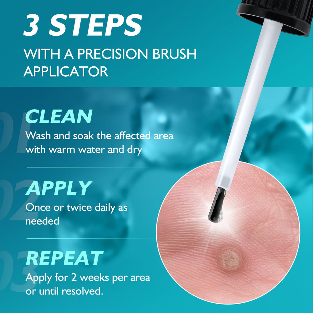 WYXTRO multi-use solution for warts and corns